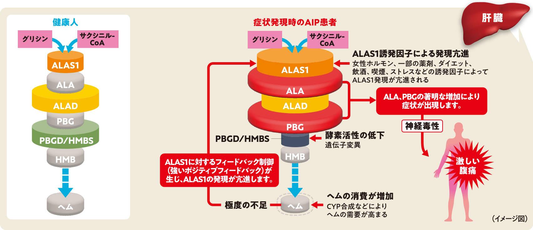 図❶ AIP患者に生じるALAとPBGの複合的な過剰産生メカニズム